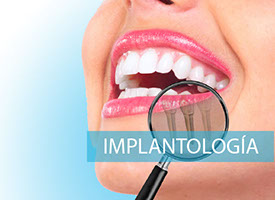 Avances en Implantología Dental: Restaurando Sonrisas con Experticia.